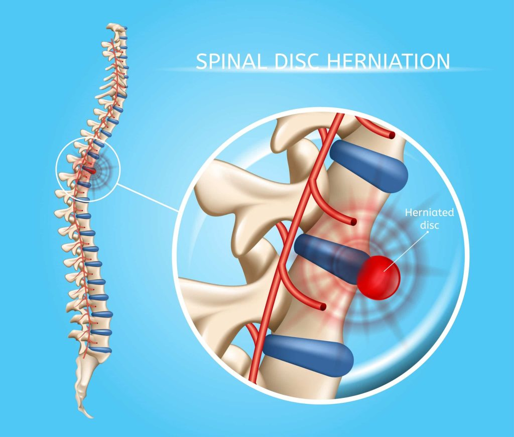 Disc Herniation